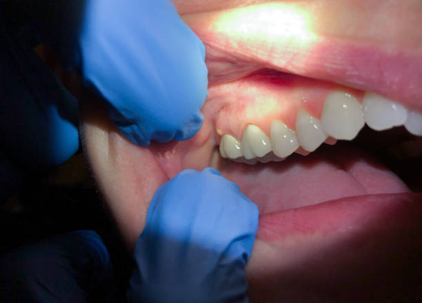 Best Emergency Dental Care for Sports Injuries in Bear Creek, FL